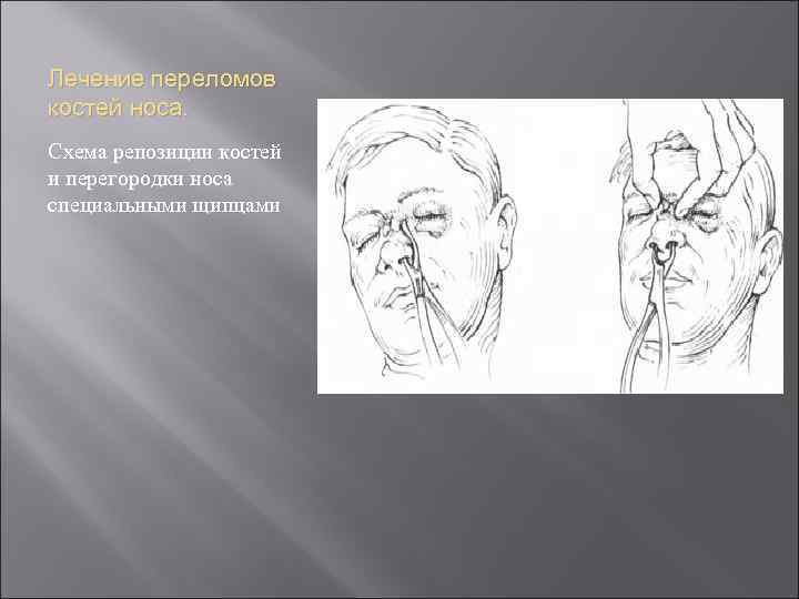 Лечение переломов костей носа. Схема репозиции костей и перегородки носа специальными щипцами 