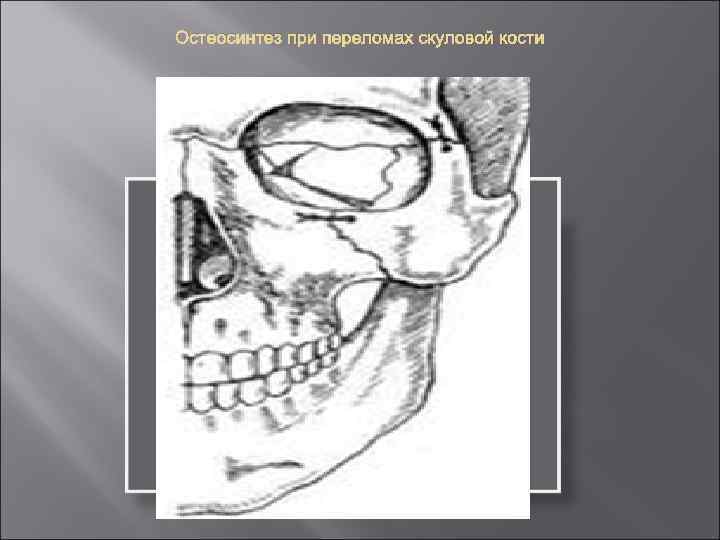 Презентация перелом скуловой кости thumbnail