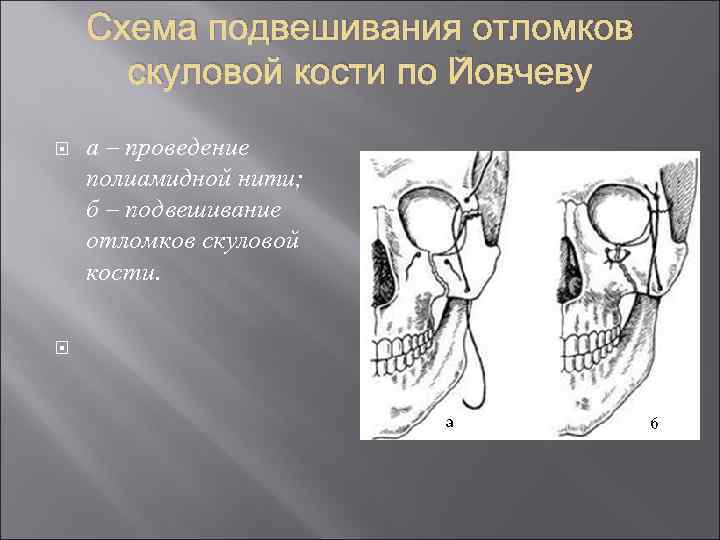 Схема подвешивания отломков скуловой кости по Йовчеву а – проведение полиамидной нити; б –