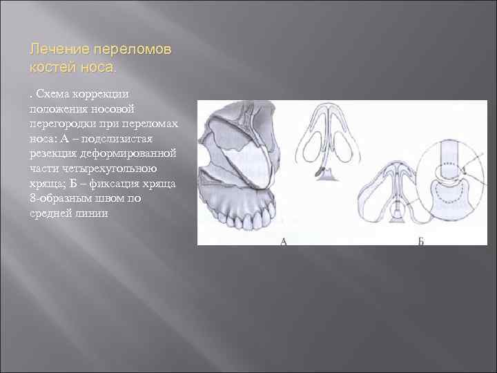 Лечение переломов костей носа. . Схема коррекции положения носовой перегородки при переломах носа: А