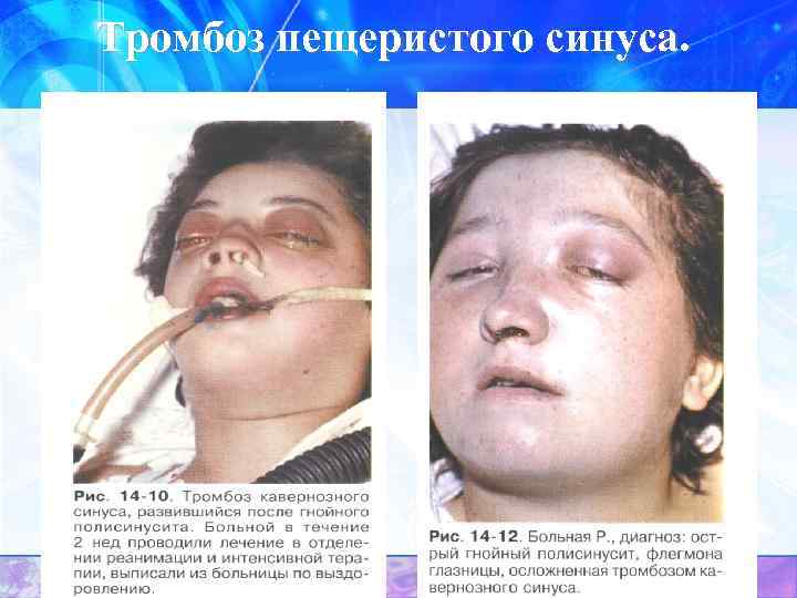 Тромбоз пещеристого синуса. 