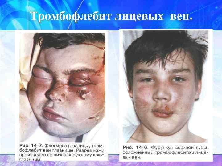 Тромбофлебит лицевых вен. 