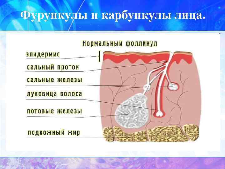Фурункулы и карбункулы лица. 