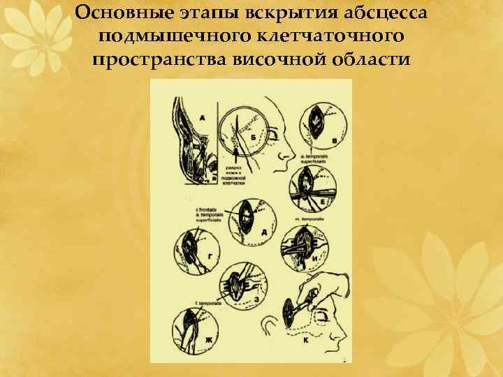 Основные этапы вскрытия абсцесса подмышечного клетчаточного пространства височной области 