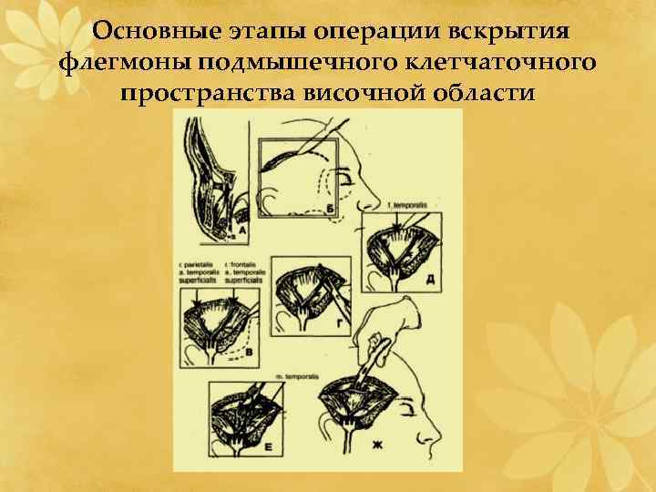  Основные этапы операции вскрытия флегмоны подмышечного клетчаточного пространства височной области 