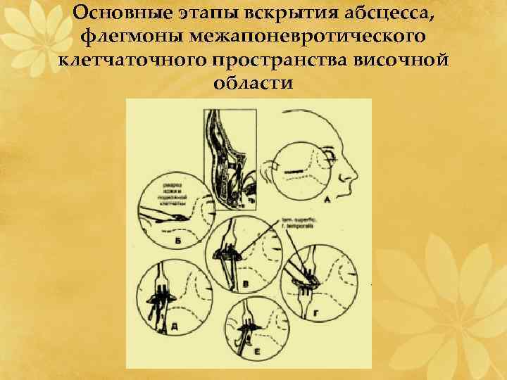 Основные этапы вскрытия абсцесса, флегмоны межапоневротического клетчаточного пространства височной области 