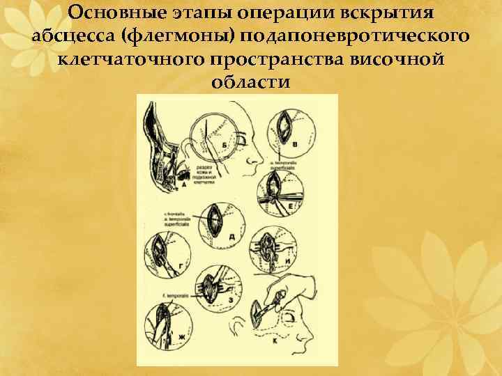 Основные этапы операции вскрытия абсцесса (флегмоны) подапоневротического клетчаточного пространства височной области 