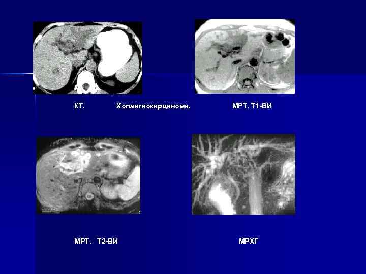 КТ. Холангиокарцинома. МРТ. Т 2 -ВИ МРТ. Т 1 -ВИ МРХГ 