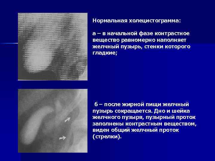 Нормальная холецистограмма: а – в начальной фазе контрастное вещество равномерно наполняет желчный пузырь, стенки