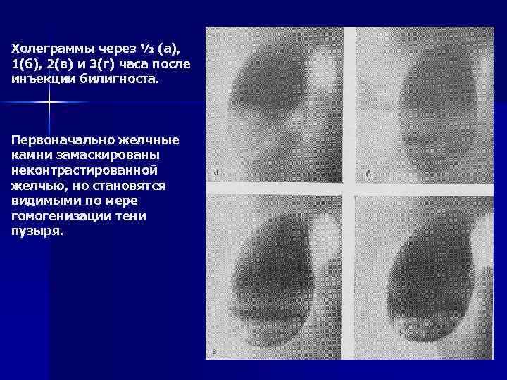 Холеграммы через ½ (а), 1(б), 2(в) и 3(г) часа после инъекции билигноста. Первоначально желчные