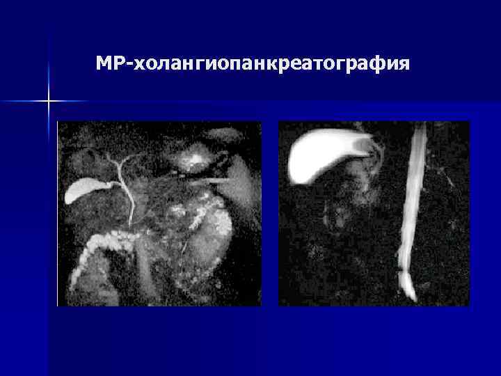 МР-холангиопанкреатография 