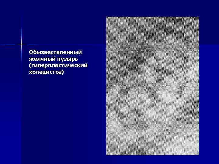 Обызвествленный желчный пузырь (гиперпластический холецистоз) 