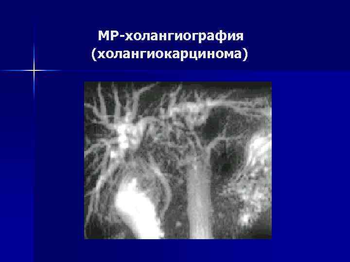 МР-холангиография (холангиокарцинома) 