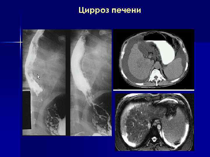 В клинической картине цирроза печени выделяют синдромы