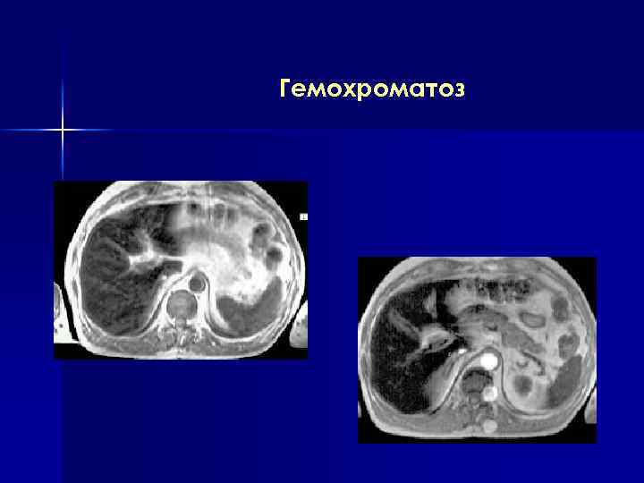 Гемохроматоз 
