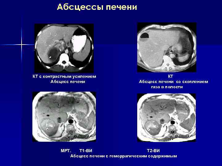 Абсцесс печени картинки