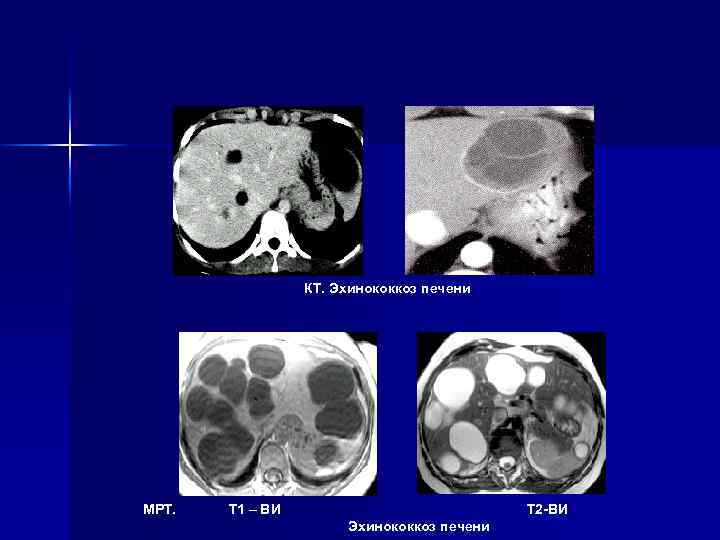 Киста печени мрт. Киста печени эхинококк кт. Эхинококкоз печени мрт. Альвеолярный эхинококкоз печени кт. Эхинококковая киста печени мрт.
