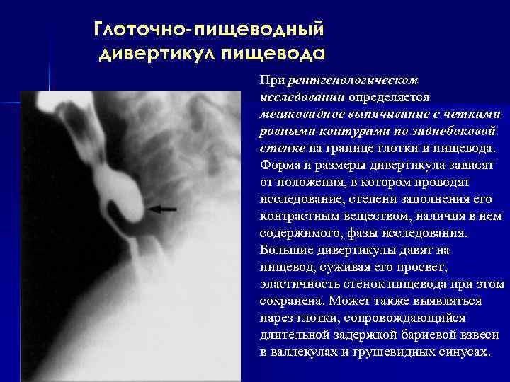 Глоточно-пищеводный дивертикул пищевода При рентгенологическом исследовании определяется мешковидное выпячивание с четкими ровными контурами по