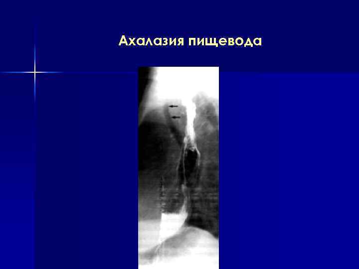 Ахалазия пищевода 