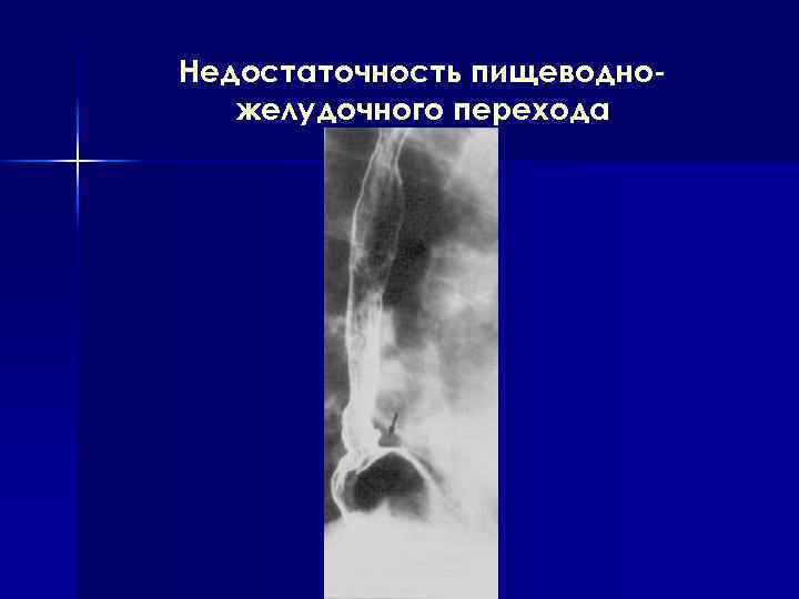Недостаточность пищеводножелудочного перехода 