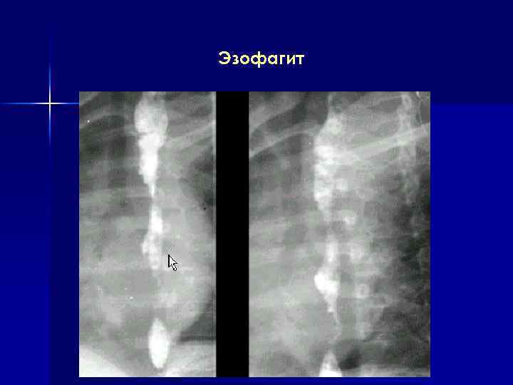 Эзофагит 