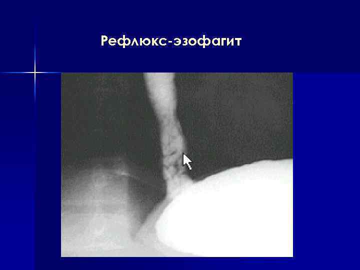 Рефлюкс-эзофагит 