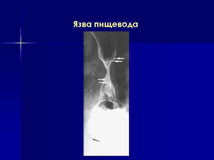 Язва пищевода 