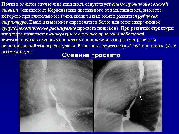 Почти в каждом случае язве пищевода сопутствует спазм противоположной стенки (симптом де Кервена) или