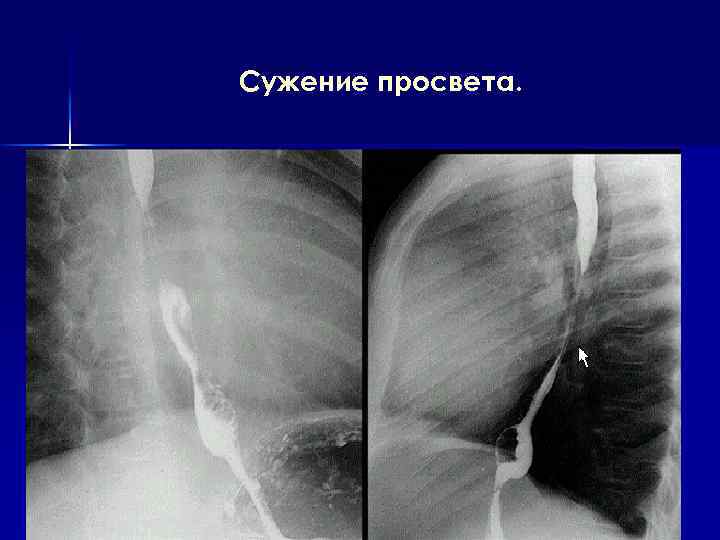 Сужение просвета. 