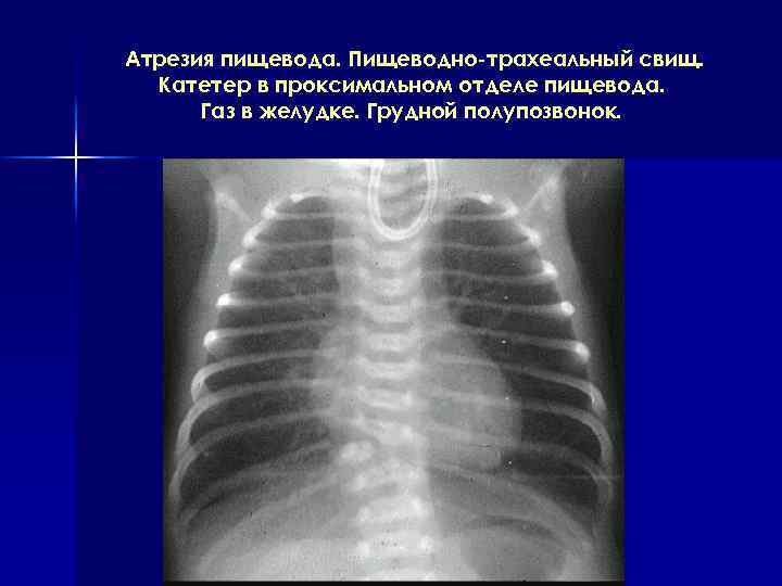 Атрезия пищевода. Пищеводно-трахеальный свищ. Катетер в проксимальном отделе пищевода. Газ в желудке. Грудной полупозвонок.