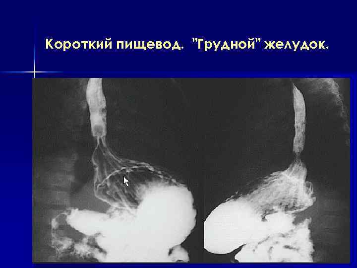 Короткий пищевод. 