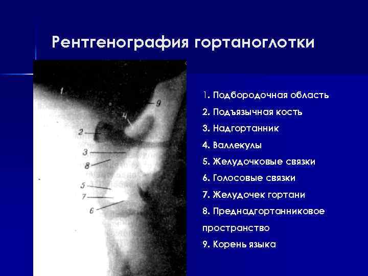 Рентгенография гортаноглотки 1. Подбородочная область 2. Подъязычная кость 3. Надгортанник 4. Валлекулы 5. Желудочковые