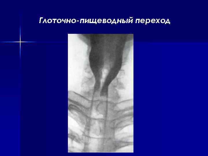 Глоточно-пищеводный переход 