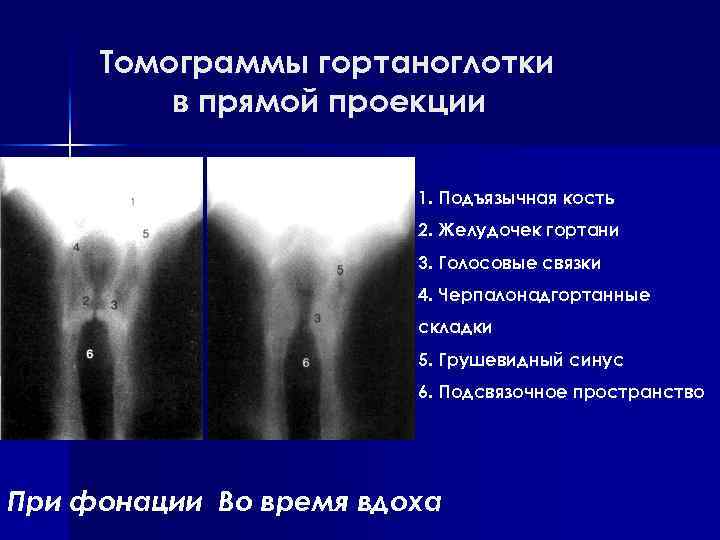 Томограммы гортаноглотки в прямой проекции 1. Подъязычная кость 2. Желудочек гортани 3. Голосовые связки