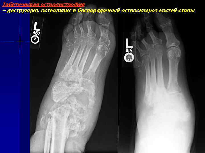 Табетическая остеодистрофия – деструкция, остеолизис и беспорядочный остеосклероз костей стопы 