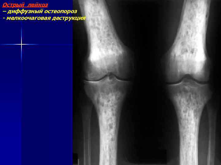 Острый лейкоз – диффузный остеопороз - мелкоочаговая деструкция 