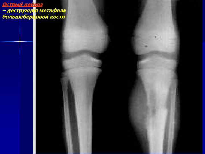 Острый лейкоз – деструкция метафиза большеберцовой кости 