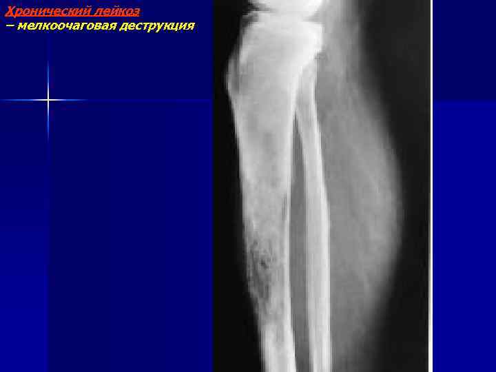 Хронический лейкоз – мелкоочаговая деструкция 