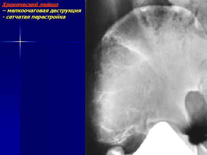 Хронический лейкоз – мелкоочаговая деструкция - сетчатая перестройка 