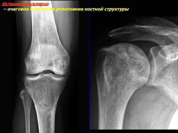 Остеомиелосклероз – очаговое и сетчатое уплотнение костной структуры 