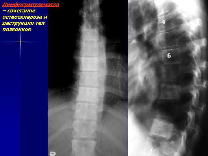 Лимфогранулематоз – сочетание остеосклероза и деструкции тел позвонков 