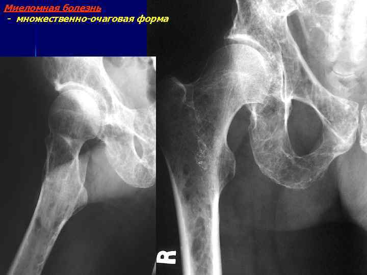 Миеломная болезнь - множественно-очаговая форма 