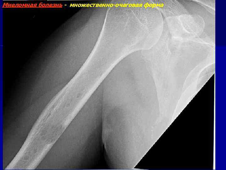Миеломная болезнь - множественно-очаговая форма 