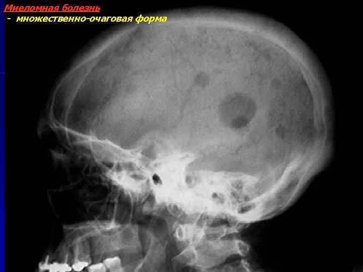 Миеломная болезнь - множественно-очаговая форма 