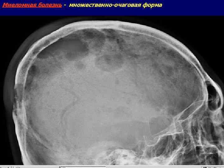 Единичные очаги дистрофического характера. Миеломная болезнь диффузно очаговая форма. Миеломная болезнь рентгенодиагностика. Множественная миелома рентген черепа.