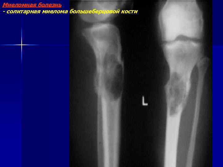 Миеломная болезнь - солитарная миелома большеберцовой кости 