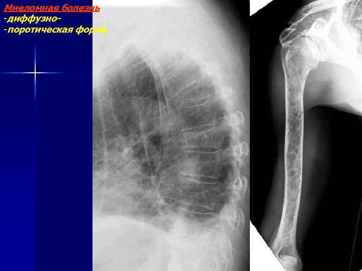 Миеломная болезнь -диффузно-поротическая форма 