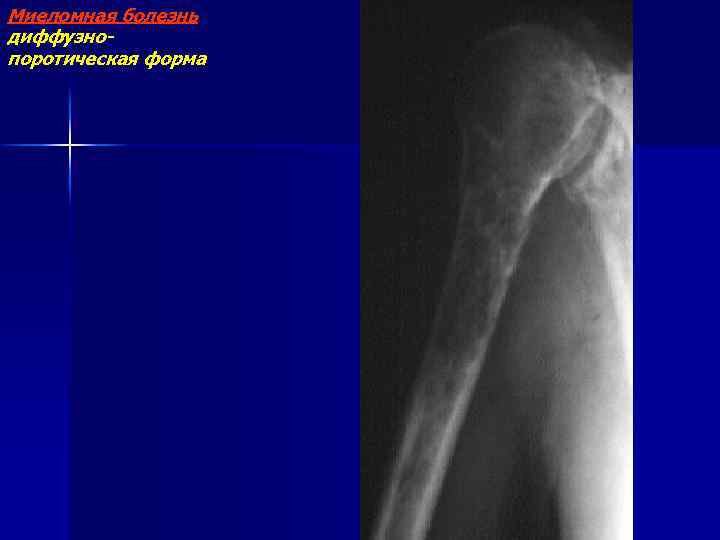 Миеломная болезнь диффузнопоротическая форма 