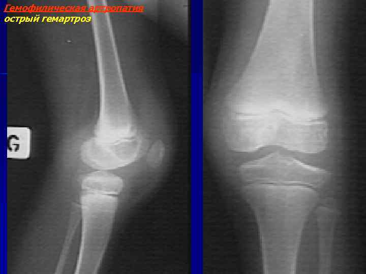 Гемофилическая артропатия острый гемартроз 