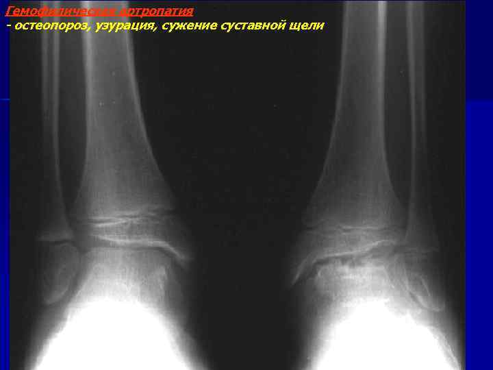 Гемофилическая артропатия - остеопороз, узурация, сужение суставной щели 